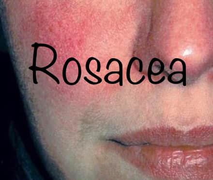 Rosacea | Healing Garden Therapies, LLC.